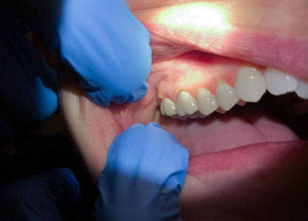 Best Cracked Tooth Emergency Dentist  in Brighton, CO